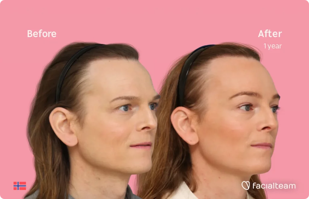 45 degree rectangular image of FFS patient Andrea showing the results before and after facial feminization surgery consisting of forehead, traquea shave feminization surgery.
