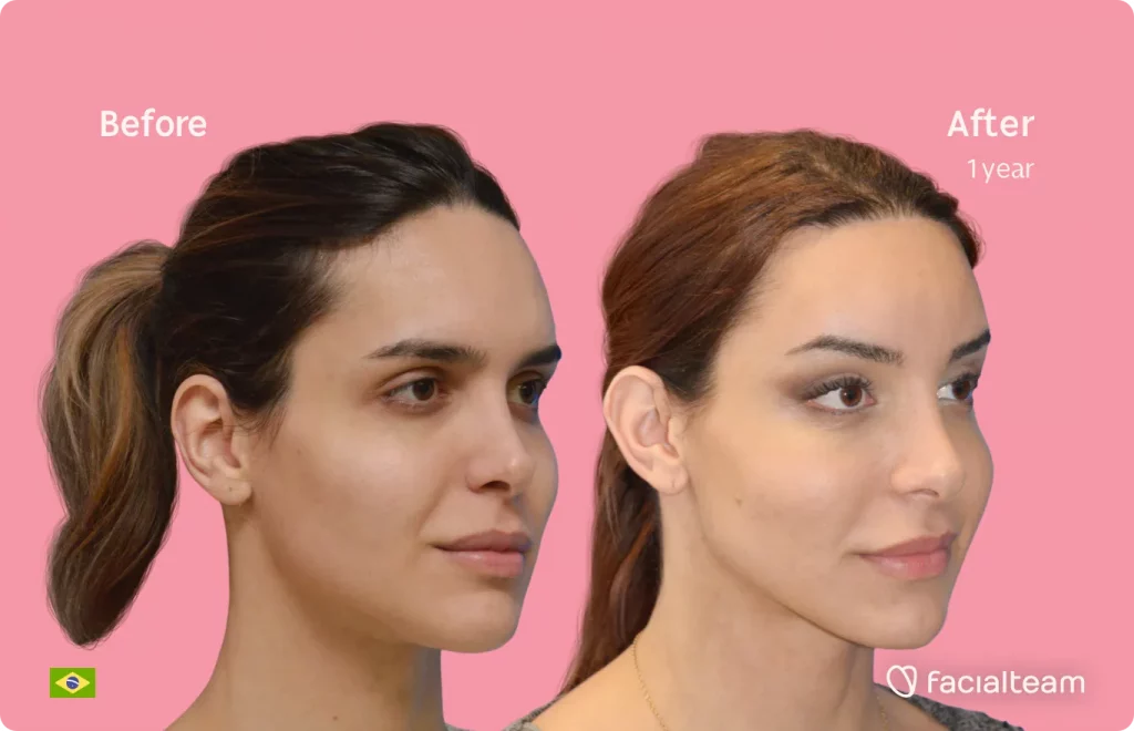 Imagen de 45 grados de Viviany, paciente de FFS, que muestra los resultados antes y después de la cirugía de feminización facial que consiste en la cirugía de feminización de la frente, el afeitado traqueal, la mandíbula y el mentón.