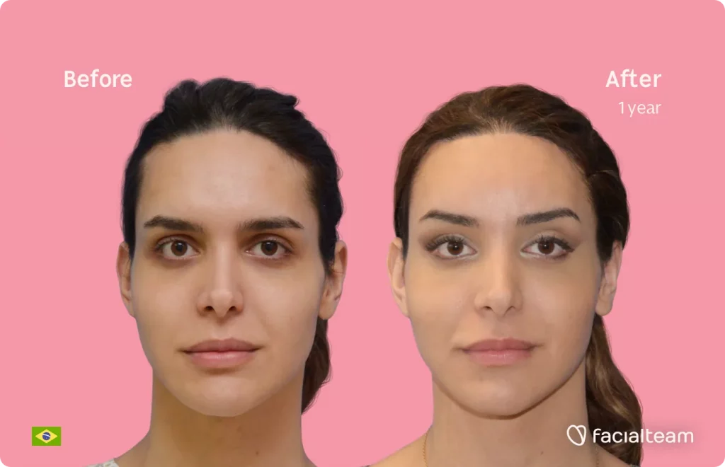 Imagen frontal de Viviany, paciente de FFS, que muestra los resultados antes y después de la cirugía de feminización facial con Facialteam, que consiste en la cirugía de feminización de la frente, el afeitado traqueal, la mandíbula y el mentón.