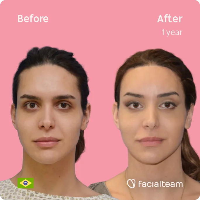 Imagen frontal cuadrada de Viviany, paciente de FFS, que muestra los resultados antes y después de la cirugía de feminización facial con Facialteam, que consiste en la cirugía de feminización de la frente, el afeitado traqueal, la mandíbula y el mentón.
