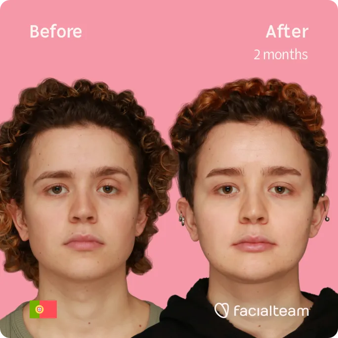 Imagen frontal cuadrada de la paciente Eunice de FFS que muestra los resultados antes y después de la cirugía de feminización facial con Facialteam que consiste en la cirugía de feminización de la frente, la mandíbula y el mentón, afeitado traqueal.