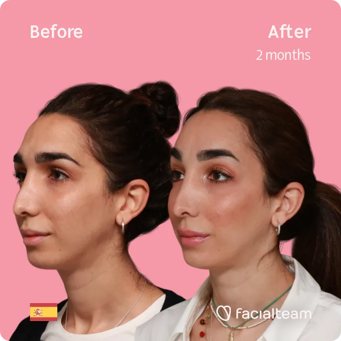 Imagen cuadrada de 45 grados a la izquierda de la paciente Lola de FFS que muestra los resultados antes y después de la cirugía de feminización facial que consiste en la cirugía de feminización de la frente.