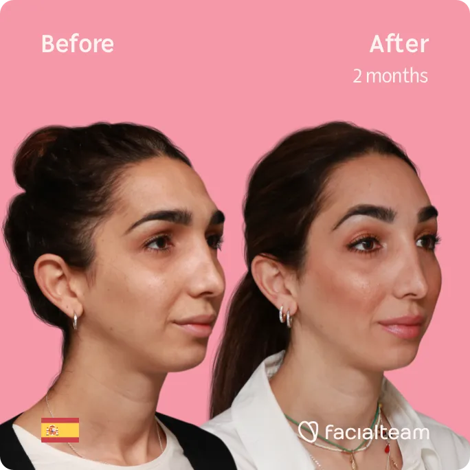 Imagen cuadrada de 45 grados a la derecha de la paciente Lola de FFS que muestra los resultados antes y después de la cirugía de feminización facial que consiste en la cirugía de feminización de la frente.