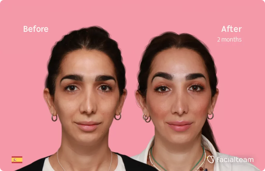 Imagen frontal de la paciente Lola de FFS que muestra los resultados antes y después de la cirugía de feminización facial con Facialteam que consiste en la cirugía de feminización de la frente.