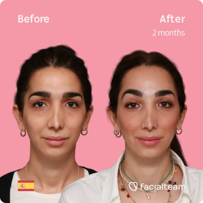 Imagen frontal cuadrada de la paciente Lola de FFS que muestra los resultados antes y después de la cirugía de feminización facial con Facialteam que consiste en la cirugía de feminización de la frente.