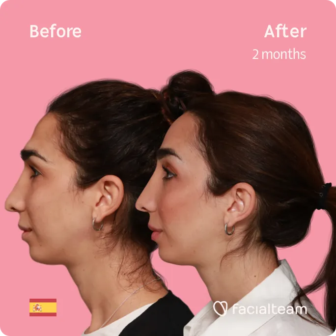 Imagen cuadrada del lado izquierdo de la paciente Lola de FFS que muestra los resultados antes y después de la cirugía de feminización facial con Facialteam que consiste en la cirugía de feminización de la frente.