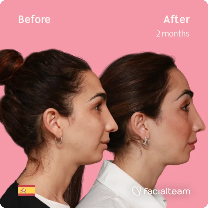 Imagen cuadrada del lado derecho de la paciente Lola que muestra los resultados antes y después de la cirugía de feminización facial con Facialteam que consiste en la cirugía de feminización de la frente.