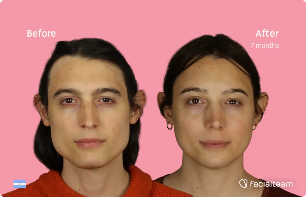 Imagen frontal de la paciente de FFS Simone que muestra los resultados antes y después de la cirugía de feminización facial con Facialteam que consiste en cirugía de feminización de la frente, la mandíbula y el mentón, rinoplastia.