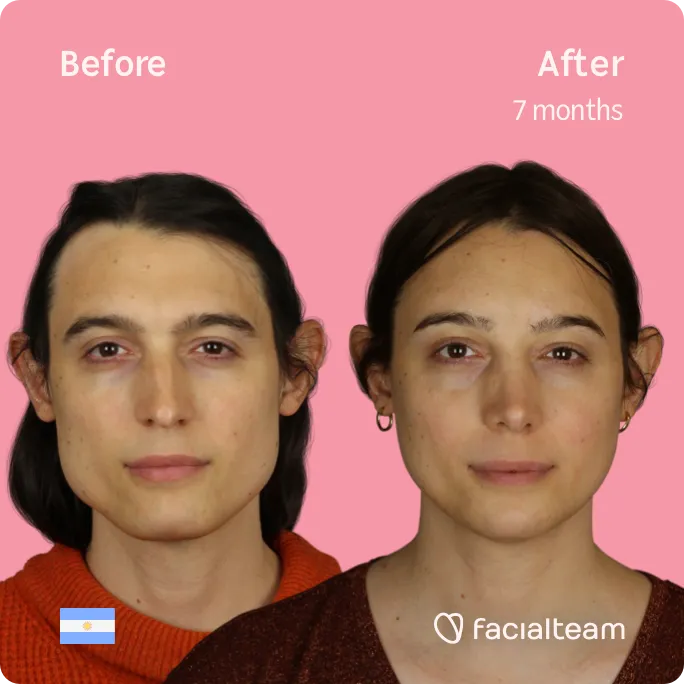 Imagen frontal cuadrada de la paciente de FFS Simone que muestra los resultados antes y después de la cirugía de feminización facial con Facialteam que consiste en la cirugía de feminización de la frente, la mandíbula y el mentón, rinoplastia.