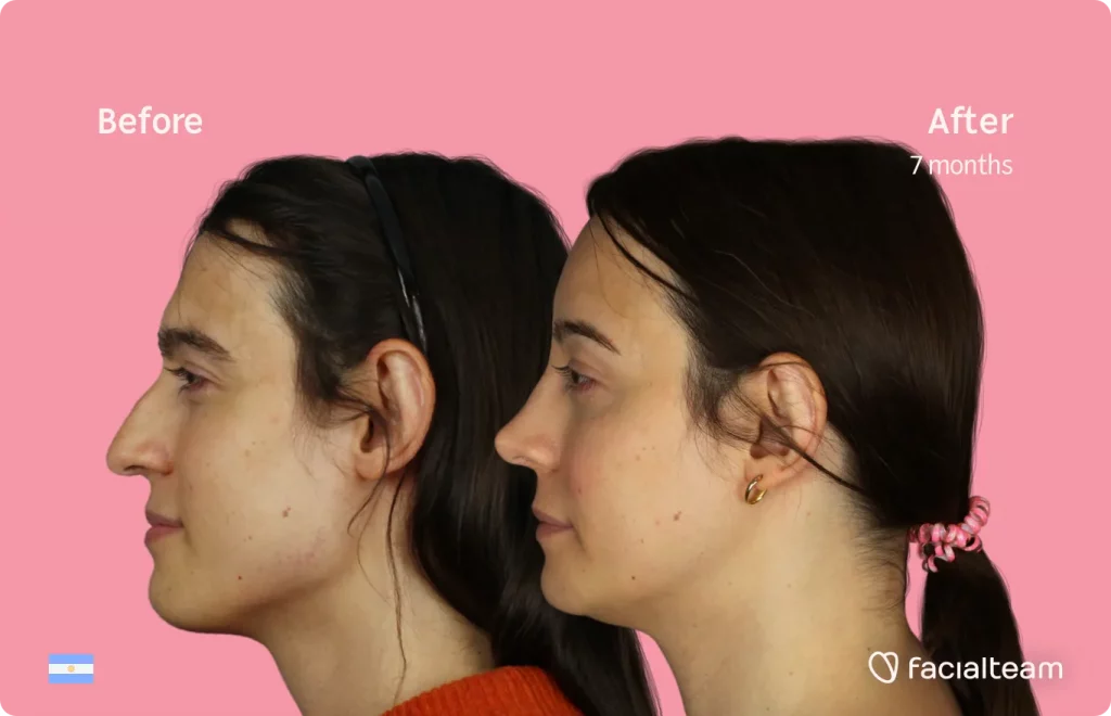 Imagen lateral de la paciente de FFS Simone que muestra los resultados antes y después de la cirugía de feminización facial con Facialteam que consiste en la cirugía de feminización de la frente, la mandíbula y el mentón, rinoplastia.