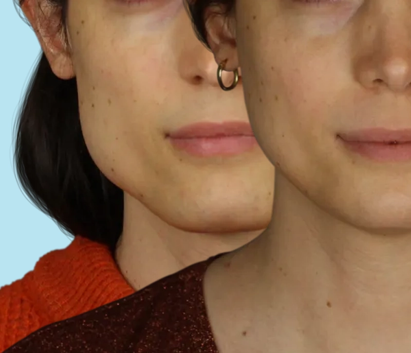Una línea de mandíbula masculina antes de someterse a la cirugía de feminización de la mandíbula y el resultado de una línea de mandíbula más femenina después de la Cirugía de Feminización Facial.