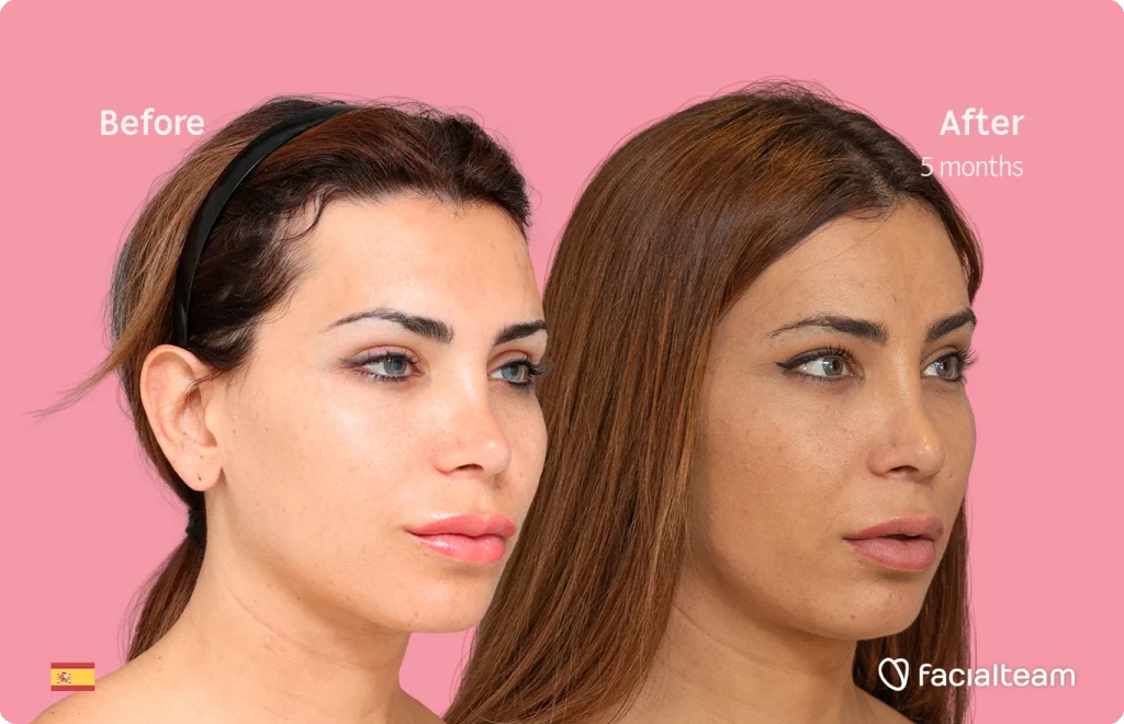 Imagen en ángulo de Daniela, paciente de Cirugía de Feminización Facial, que muestra los resultados antes y después de la cirugía de feminización facial con Facialteam, que consiste en una cirugía de feminización de la frente y el labio.