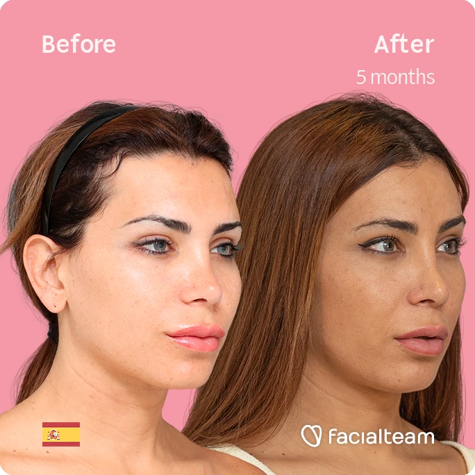 Imagen cuadrada en ángulo de Daniela, paciente de Cirugía de Feminización Facial, que muestra los resultados antes y después de la cirugía de feminización facial con Facialteam, que consiste en una cirugía de feminización de la frente y el labio.