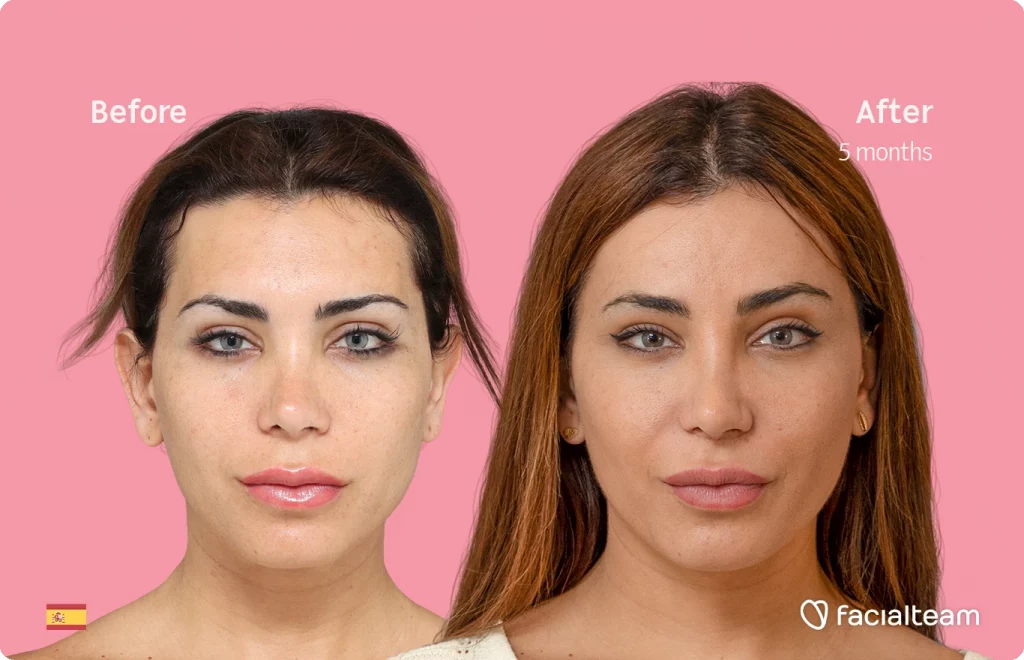 Imagen frontal de Daniela, paciente de Cirugía de Feminización Facial, que muestra los resultados antes y después de la cirugía de feminización facial con Facialteam, que consiste en una cirugía de feminización de la frente y el labio.
