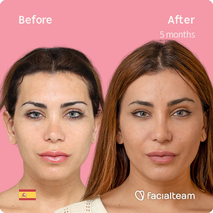 Imagen cuadrada frontal de Daniela, paciente de Cirugía de Feminización Facial, que muestra los resultados antes y después de la cirugía de feminización facial con Facialteam, que consiste en una cirugía de feminización de la frente y el labio.