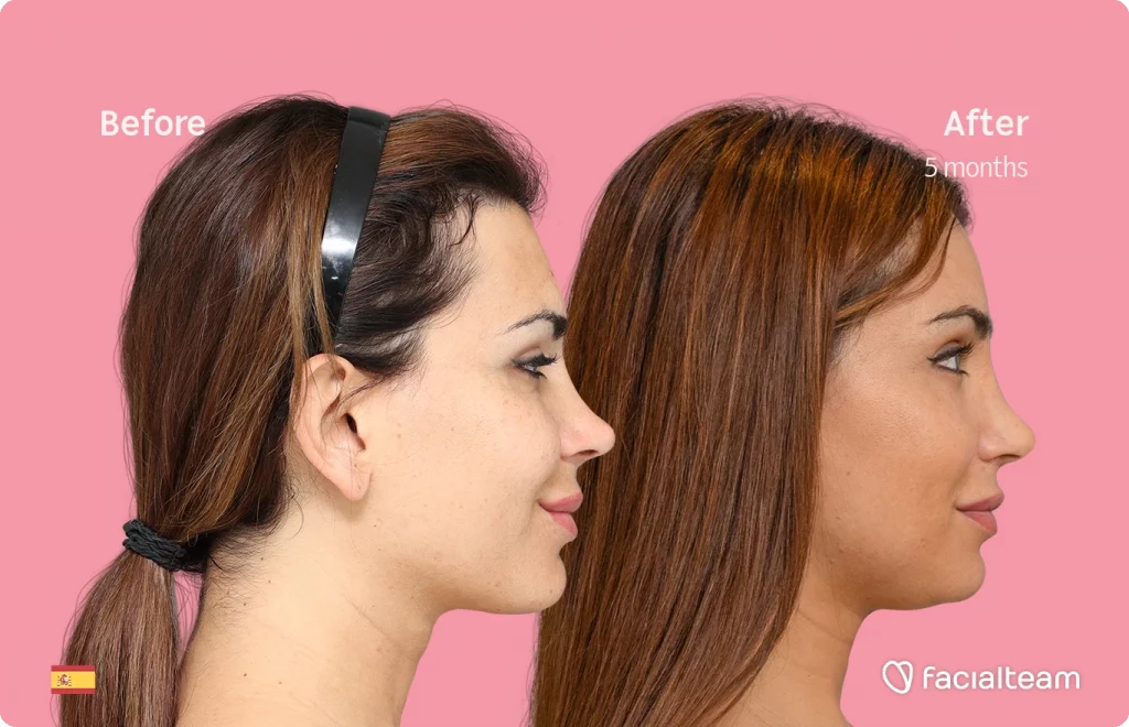 Imagen de lado de Daniela, paciente de Cirugía de Feminización Facial, que muestra los resultados antes y después de la cirugía de feminización facial con Facialteam, que consiste en una cirugía de feminización de la frente y el labio.
