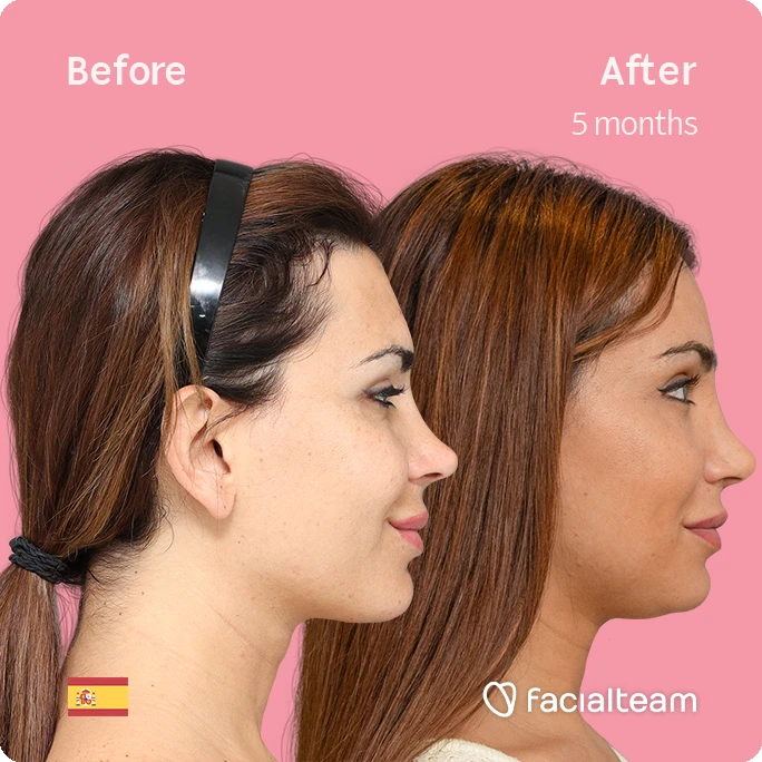 Imagen cuadrada de lado de Daniela, paciente de Cirugía de Feminización Facial, que muestra los resultados antes y después de la cirugía de feminización facial con Facialteam, que consiste en una cirugía de feminización de la frente y el labio.