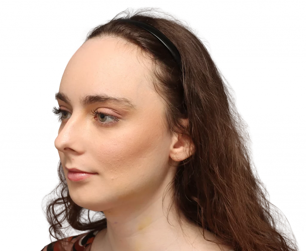 Fotografía en ángulo del perfil izquierdo de Alex M tras la cirugía.