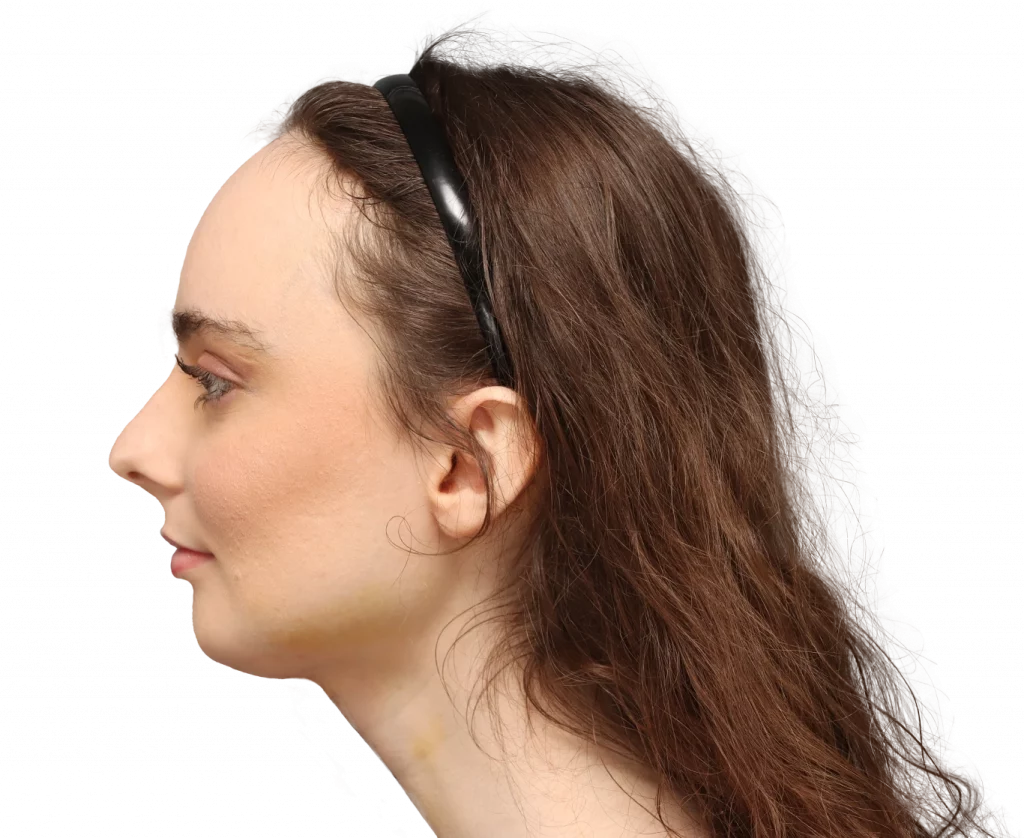 Fotografía del perfil izquierdo de Alex M tras la cirugía.