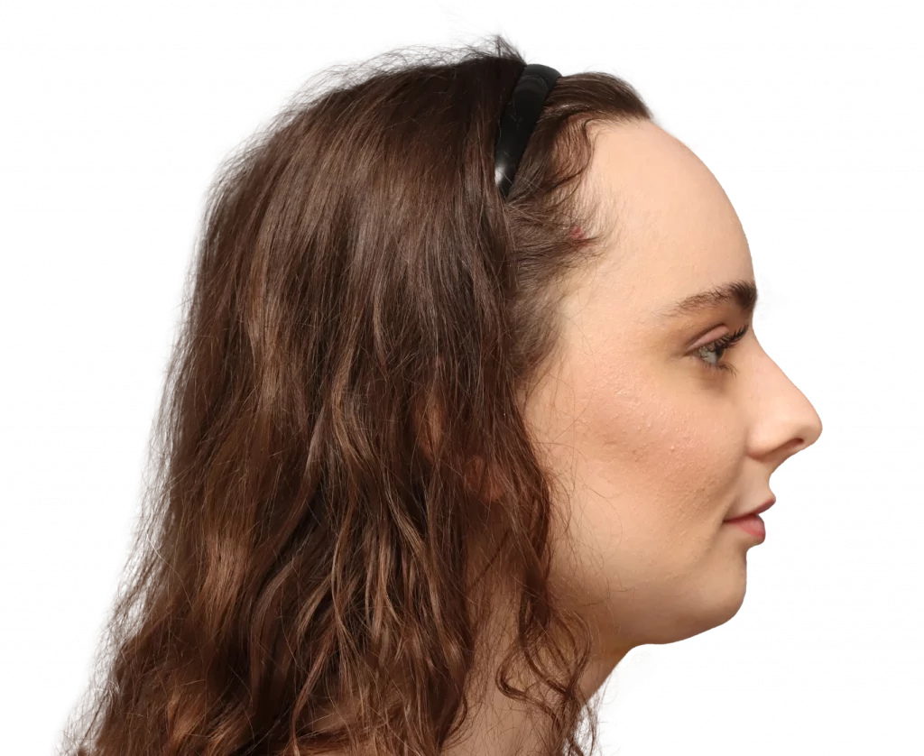 Fotografía del perfil derecho de Alex M tras la cirugía.