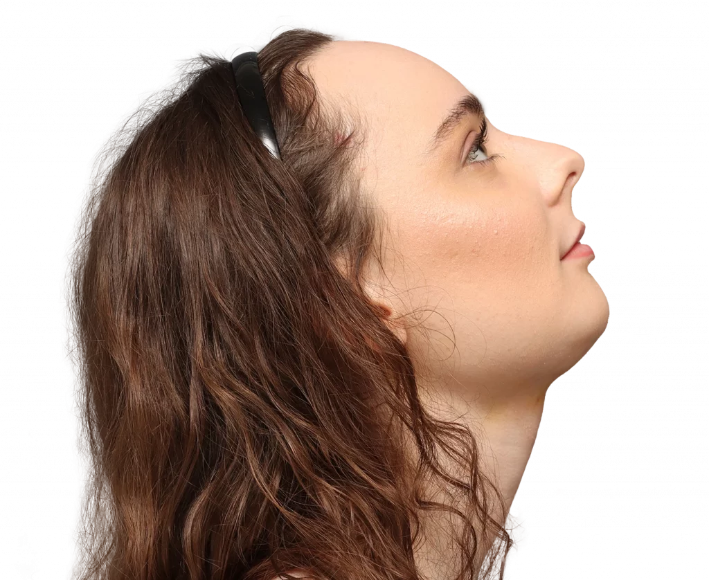 Fotografía del perfil derecho hacia arriba de Alex M tras la cirugía.