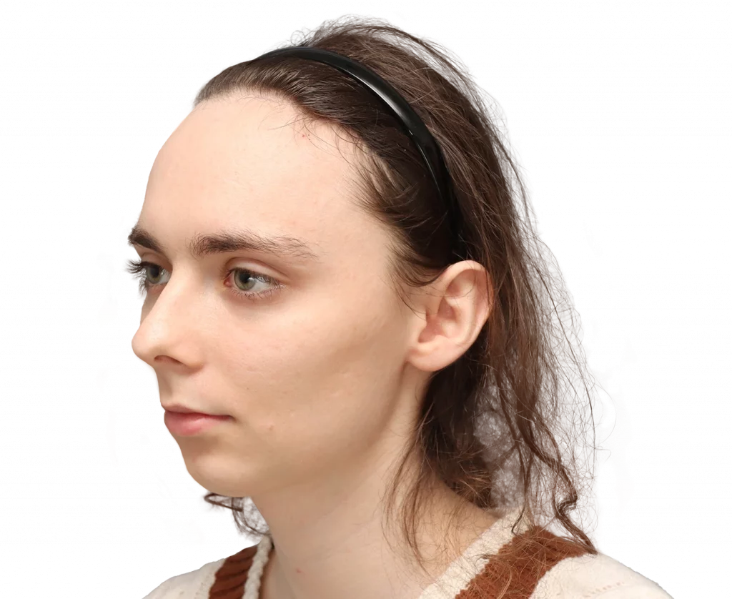 Fotografía en ángulo del perfil izquierdo de Alex M antes de la cirugía.