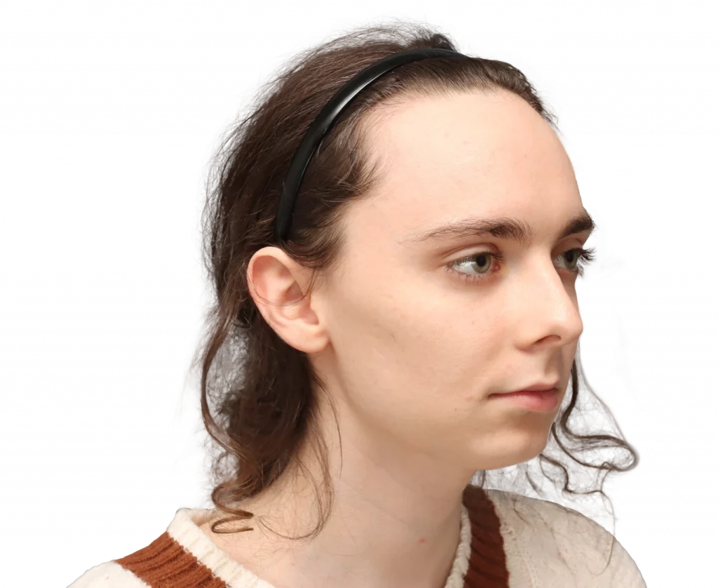 Fotografía en ángulo del perfil derecho de Alex M antes de la cirugía.