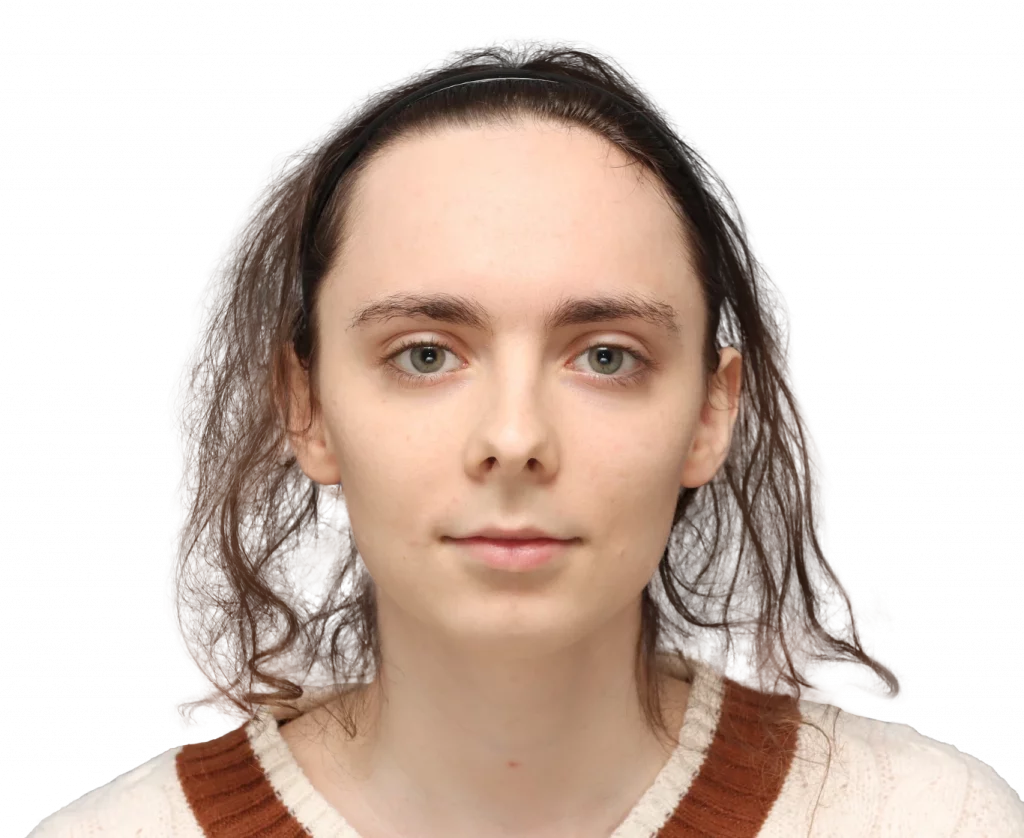 Fotografía del perfil frontal de Alex M antes de la cirugía.