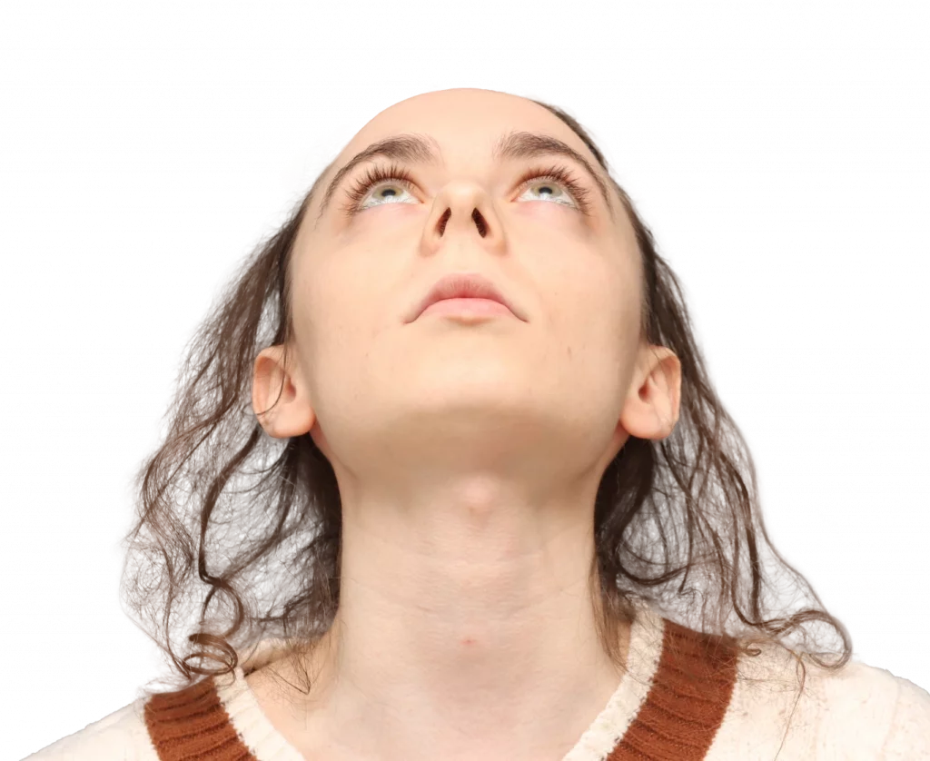 Fotografía del perfil frontal hacia arriba Alex M antes de la cirugía.