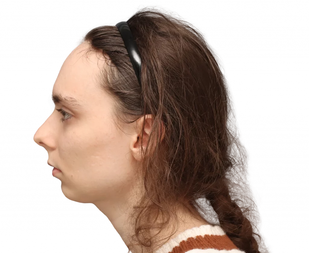 Fotografía del perfil izquierdo de Alex M antes de la cirugía.