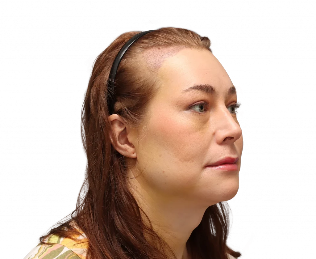 Fotografía en ángulo del perfil derecho de Juuli tras la cirugía.