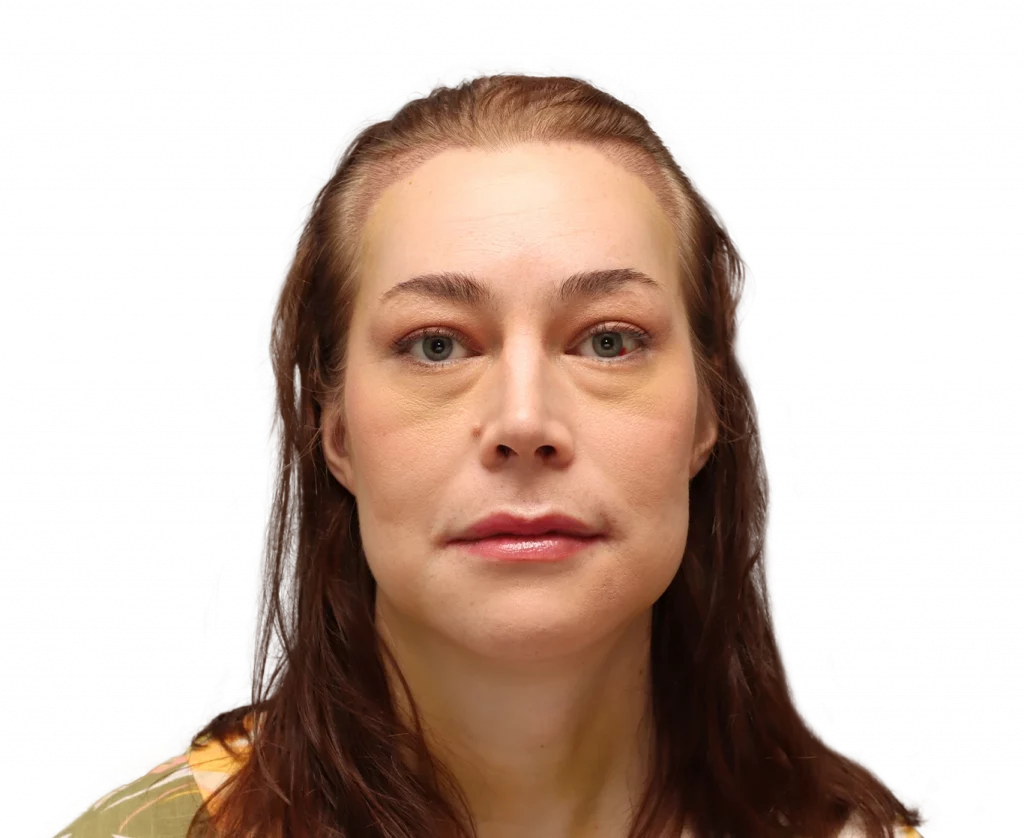 Fotografía frontal de Juuli tras la cirugía.