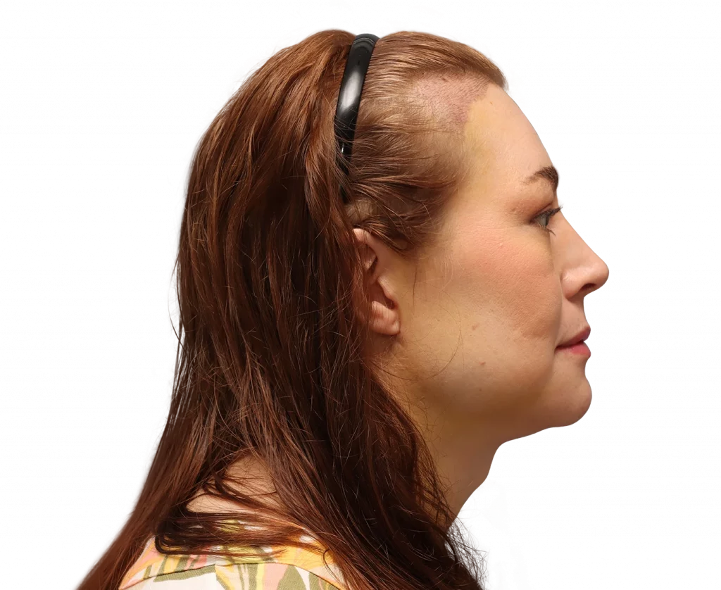 Fotografía del perfil derecho de Juuli tras la cirugía.