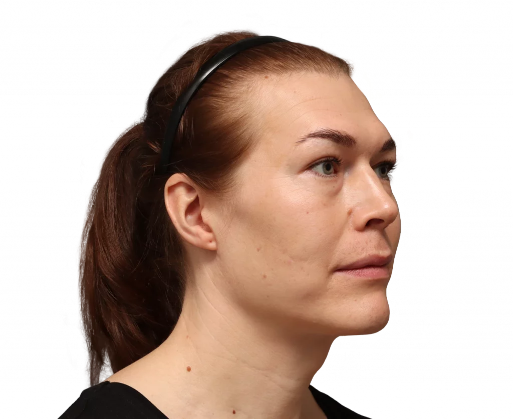 Fotografía en ángulo del perfil derecho de Juuli antes de la cirugía.