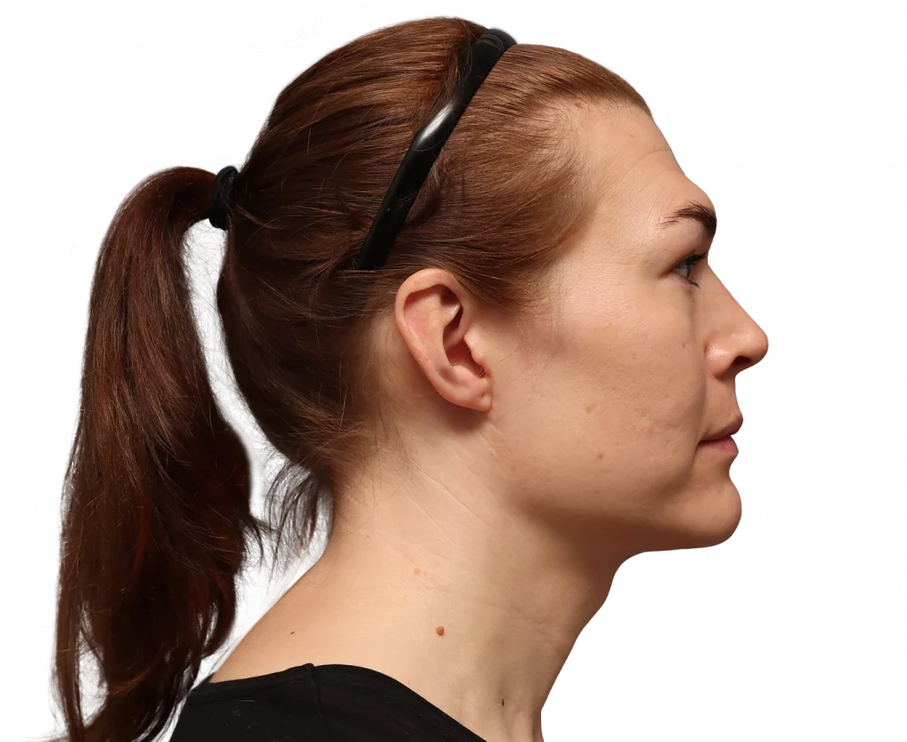 Fotografía del perfil derecho de Juuli antes de la cirugía.