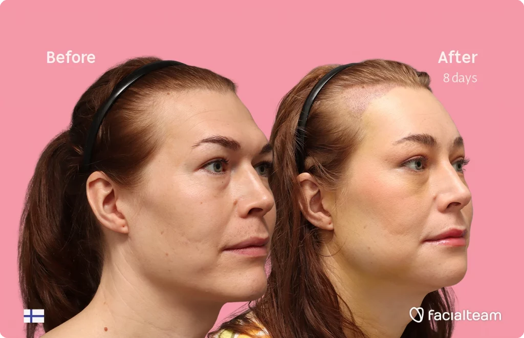 Fotografía en ángulo del perfil derecho de Juuli, mostrando su transformación antes y después de la FFS con Facialteam.