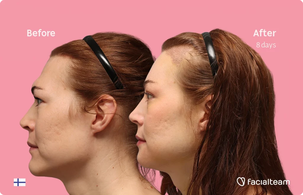 Fotografía del perfil izquierdo de Juuli, mostrando su transformación antes y después de la FFS con Facialteam.