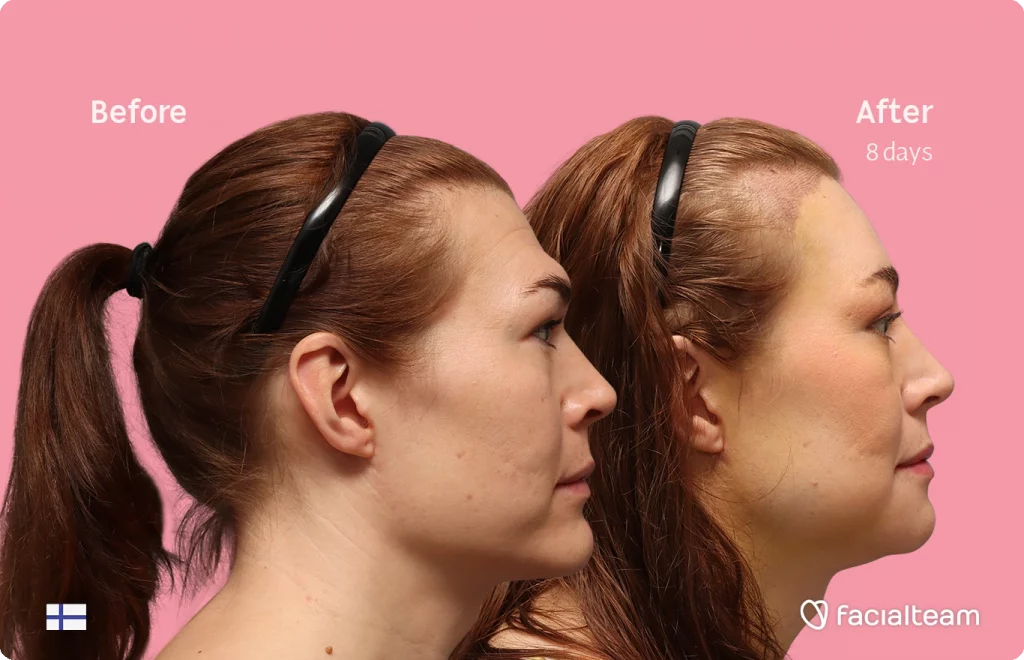 Fotografía del perfil derecho de Juuli, mostrando su transformación antes y después de la FFS con Facialteam.