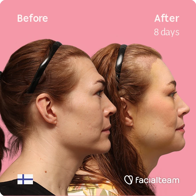 Fotografía cuadrada del perfil derecho de Juuli, mostrando su transformación antes y después de la FFS con Facialteam.