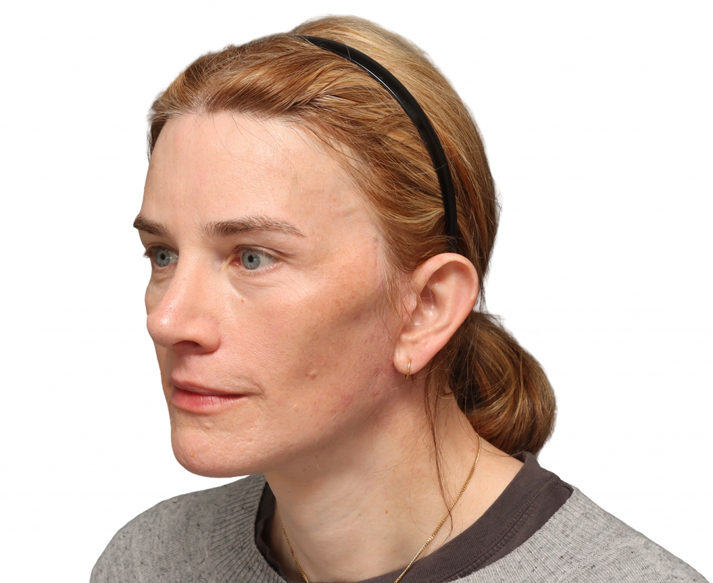 Fotografía en ángulo del perfil izquierdo de Nina S tras la cirugía.