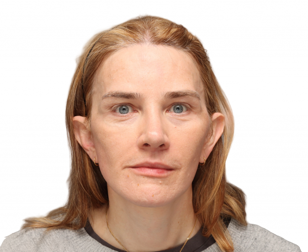 Fotografía del perfil frontal de Nina S tras la cirugía.