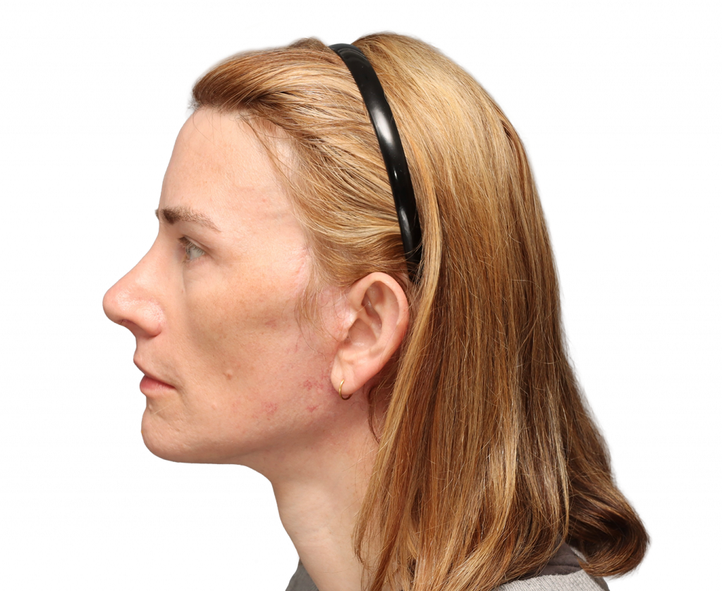 Fotografía del perfil izquierdo de Nina S tras la cirugía.