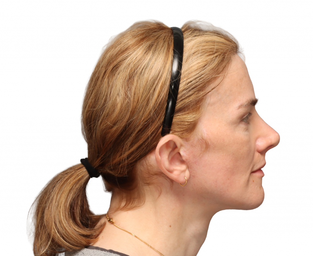 Fotografía del perfil derecho de Nina S tras la cirugía.