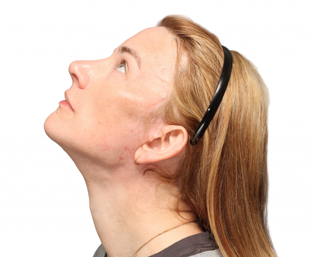 Fotografía del perfil izquierdo superior de Nina S tras la cirugía.