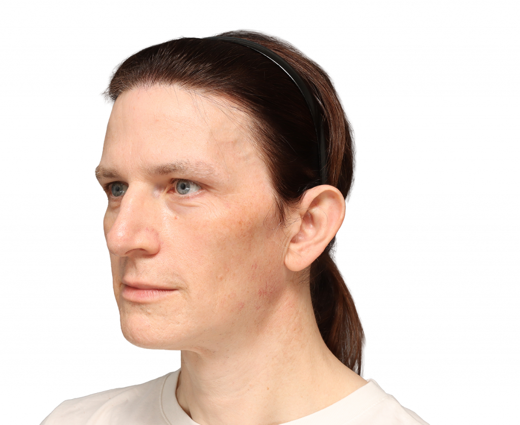 Fotografía en ángulo del perfil izquierdo de Nina S antes de la cirugía.