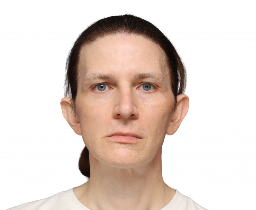 Fotografía del perfil frontal de Nina S antes de la cirugía.