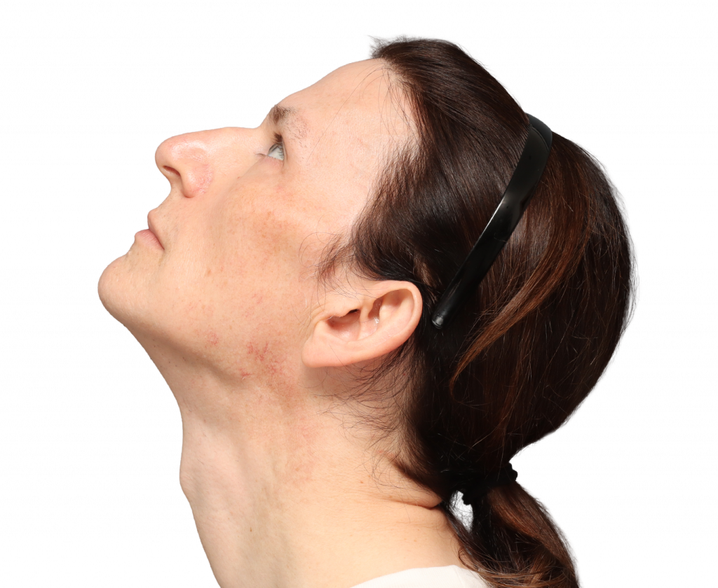 Fotografía del perfil izquierdo superior de Nina S antes de la cirugía.