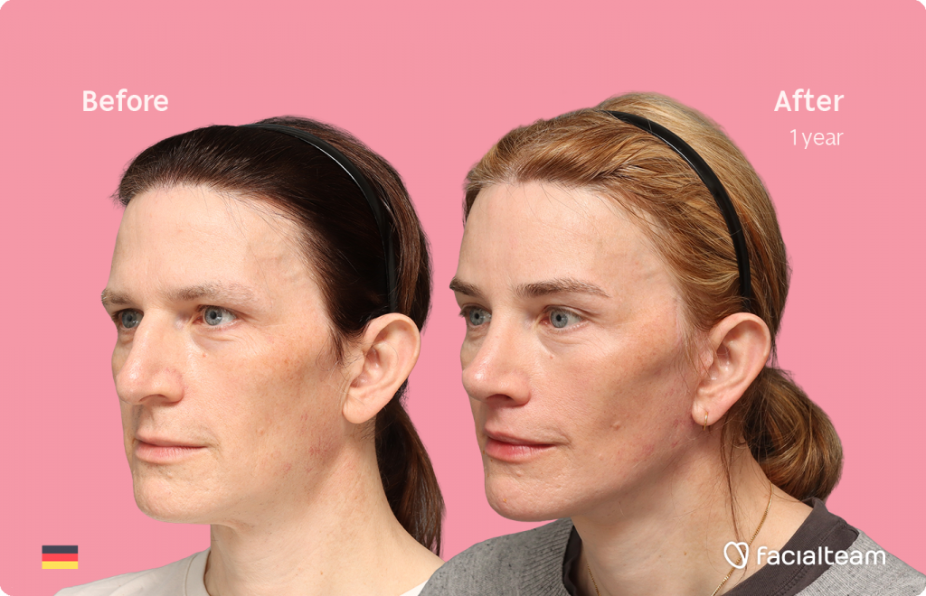 Fotografía en ángulo del perfil izquierdo de Nina S, mostrando su transformación antes y después de la FFS con Facialteam: frente, rinoplastia y reducción de la nuez, con lifting cervicofacial y feminización de labios como tratamientos complementarios.