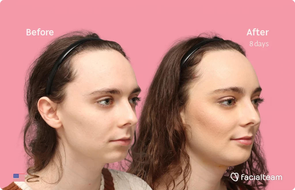 Fotografía en ángulo del perfil derecho de Alex M, mostrando su transformación antes y después de la FFS con Facialteam: frente, mentón y reducción de la nuez.