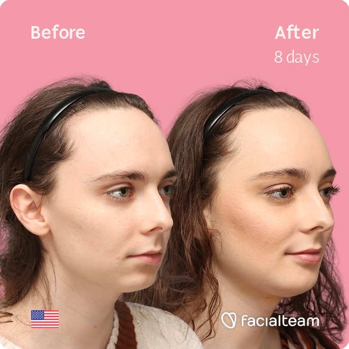 Fotografía cuadrada en ángulo del perfil derecho de Alex M, mostrando su transformación antes y después de la FFS con Facialteam: frente, mentón y reducción de la nuez.